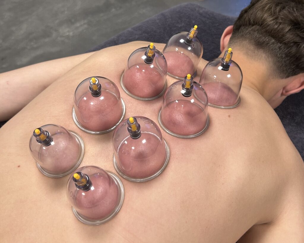 foto.behandelingen.cupping